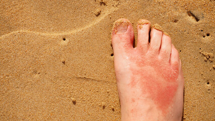 a leg affected by a skin disease, on the sea sand
