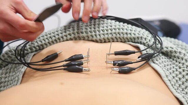 ECG Electrodes attached to an unrecognizable patient's back