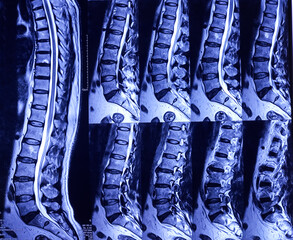 MRI (magnetic resonance imaging) of Lumbo sacral Spine. L4-L5 and L5-S1 level thecal sac...