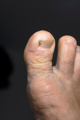 disease on human toes felon