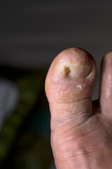 disease on human toes felon