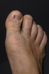 disease on human toes felon