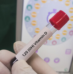 Blood sample for 1,25 (OH) Vitamin D test