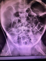 Film. X-ray show generalized bowel dilate with double bowel wall suspected necrotizing enterocolitis for medical study and technology concept 