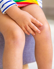 Bruises on the child legs. Selective focus.