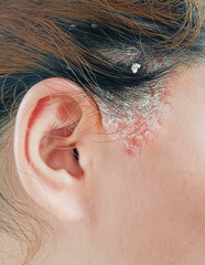 Close up sideburns girl has ringworm fungal lesions