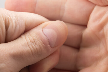 Ridged fingernail of a thumb finger of a man with horizontal ridges