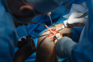 close-up of a severed human knee on an operating table where knee replacement surgery is being...