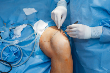 close-up of a severed human knee on an operating table where knee replacement surgery is being performed
