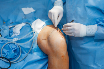 Fototapeta premium close-up of a severed human knee on an operating table where knee replacement surgery is being performed