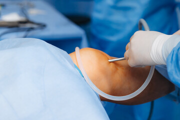 02.01.2024 Vinnytsia, Ukraine: two trauma surgeons work on a patient's knee joint reconstruction on...