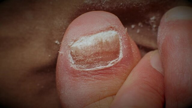 emery boards filing down a big toe nail with fungal infections. close up