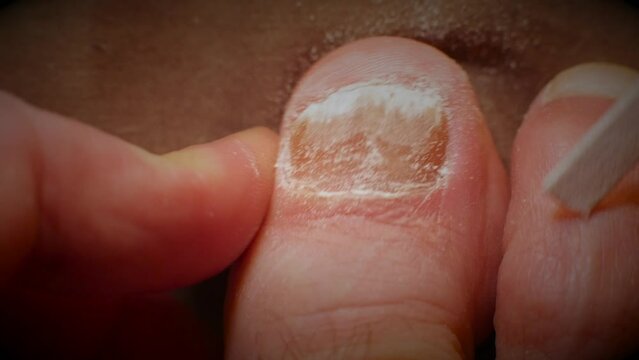 Eagerly filing down big toe nail with fungal infection in macro shot.