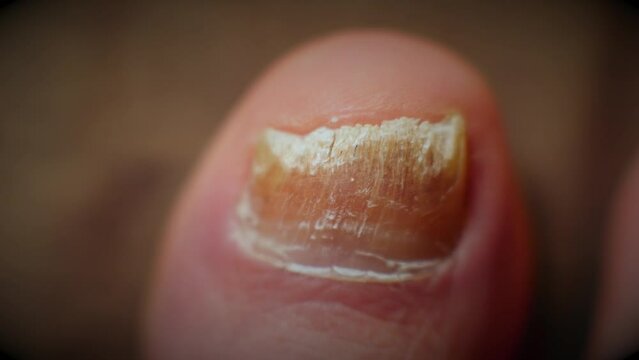  Well-lit macro shot showcasing big toe nail with fungal infection