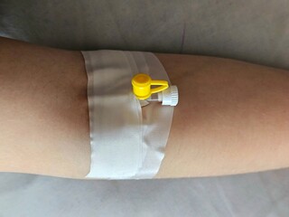 catheter for blood test. catheter in a vein in a patient. Image of a hand with a catheter for blood test from a vein. Patient with intravenous cannula in arm. close up