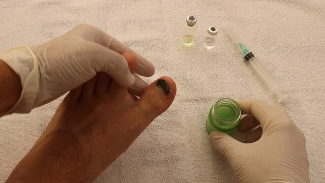 dermatologist who treats heel spur and athlete's foot with herbal cream. Bloody toenail treatment.	