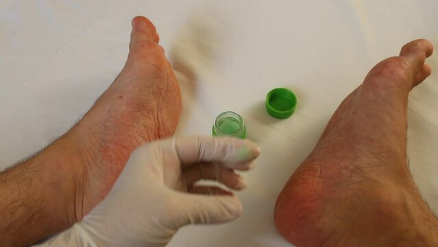 dermatologist who treats heel spur and athlete's foot with herbal cream. Bloody toenail treatment.