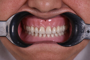 Frontal view of a complete removable prothesis placed in human mouth 