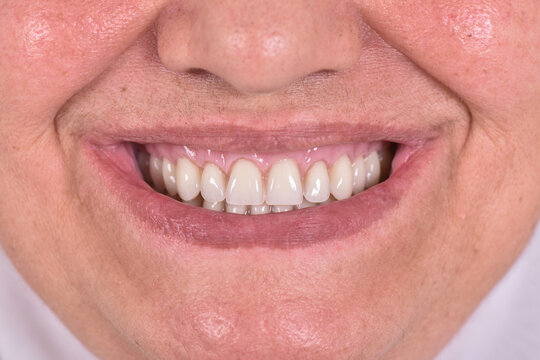 A close-up of a human mouth slightly parted lips, revealing white and healthy teeth which is a removable prothesis