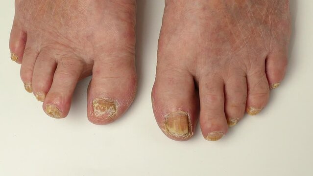 Toenail fungus. Nails affected by a fungal infection. Onycholysis of nails, paramedicine, medical pedicure, aging problems