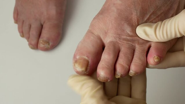 Toenail fungus. A podologist examines toenails affected by a fungal infection. Onycholysis of nails, Paramedicine, Medical pedicure, aging problems