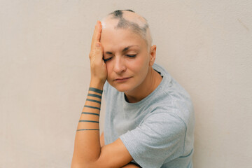 Real alopecia areata in a young girl. A bald head in a person. Diffuse alopecia