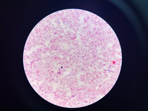 red cell Gram negative bacilli in hemoculture.