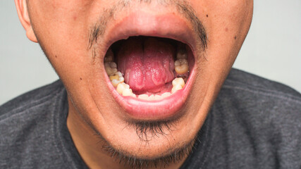 Closeup mouth with cavity.