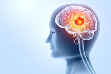 Brain tumor or barin cancer. 3d illustration