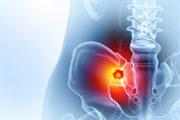 Hip bone cancer or tumor, one side pain. 3d illustration
