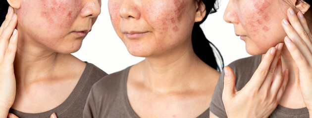 A face of Asian woman who had facial skin treatment by Co2 laser to treat her Acne Scars to get...