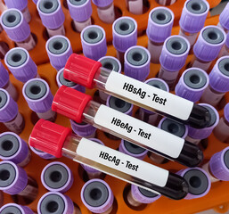 Blood samples for HBsAg, HBeAg and HBcAg test. Hepatitis B Antigen panel testing.