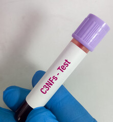 Blood sample for C3NFs (C3 Nephritic Factor) test. an autoantibody to the alternate complement...