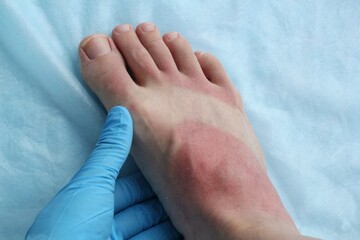 A doctor in blue gloves makes examines a redness woman's leg as result of skin burn. Foot soreness after sunburn. Dermatology problems. Inflammation sensitive skin from allergies. Thermal burn