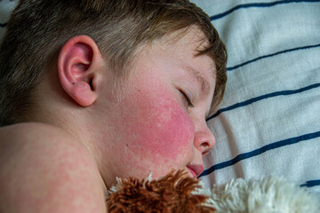 Viral disease. Measles rash on the body of the child. Allergy