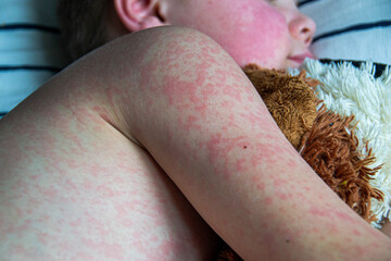Viral disease. Measles rash on the body of the child. Allergy