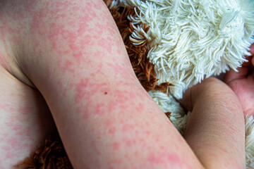 Viral disease. Measles rash on the body of the child. Allergy
