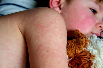 Viral disease. Measles rash on the body of the child. Allergy