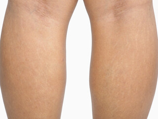 Stretch marks on legs skin of woman on white background. Closeup photo, blurred.