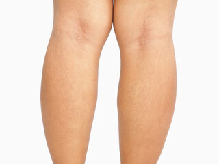 Woman fat have cellulite and  stretch mark on her leg. Closeup photo, blurred.