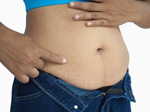 Woman show off the belly after birth have stretch marks on white background. Closeup photo, blurred.