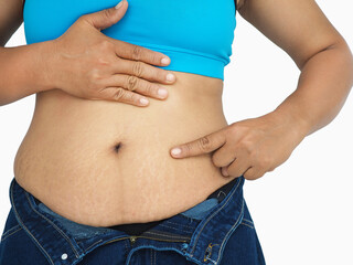 Asian woman show off displaying stretch marks on her abdomen after pregnancy caused by tearing of the dermis layer of the skin. Closeup photo, blurred.