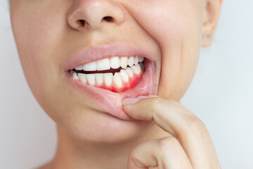 Gum inflammation. Cropped shot of a young woman showing red bleeding gums isolated on a grey...