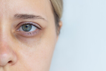 Cropped shot of a young caucasian woman's face with dark circle under eye isolated on a grey...