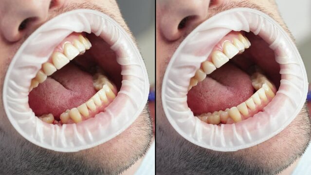 Before and after dental tooth implantation. Split screen. Dental surgery