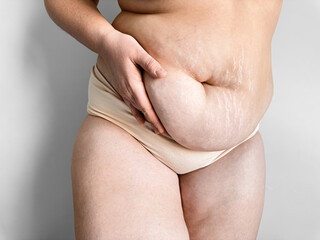 Postpartum womans midsection showing stretch marks, body positivity and real post pregnancy changes concept.