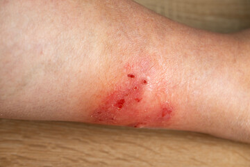 itchy skin on leg, inflammation and Medical Allergies, disease on body female patient, Dermatology...