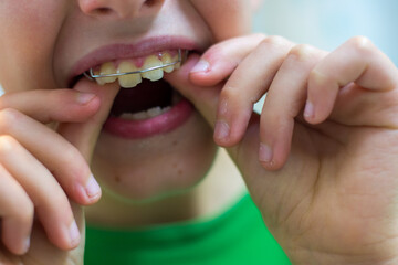 A child putting on his dental braces, holding the braces in his arms. Dentist and orthodontist...