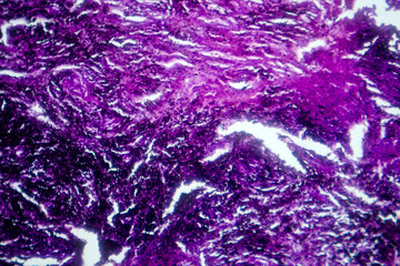Photomicrograph of lung tissue with silicosis pathology under a microscope, revealing silica...