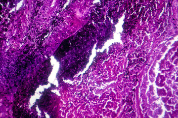 Photomicrograph of lung tissue with silicosis pathology under a microscope, revealing silica...